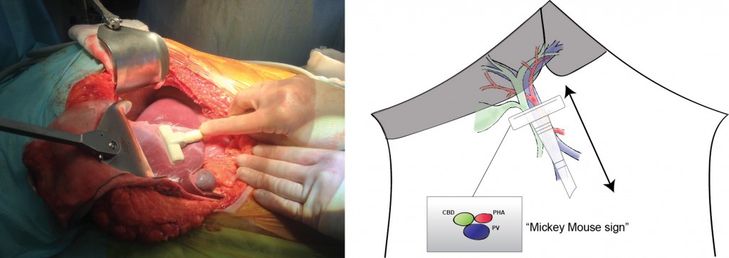 Intraoperative ultrasound to portal pedicle. Patient consent for publication obtained.