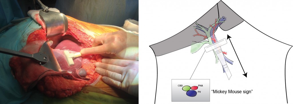 Intraoperative ultrasound to portal pedicle. Patient consent for publication obtained. 