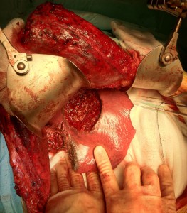 Multiple local liver resections. Patient provided consent for image publication. 